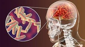 tuberculosis meningitis